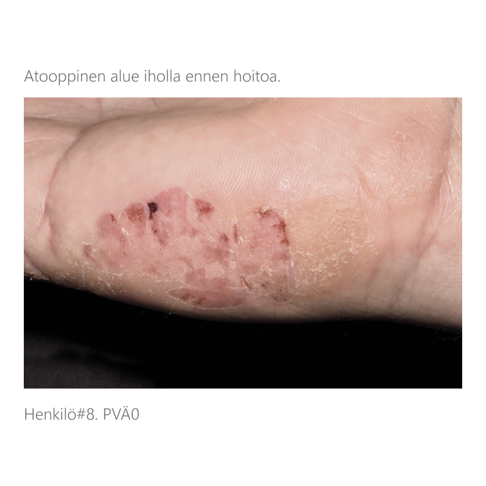 Käden-atooppinen-iho-ennen-skinGuide-probioottiöljyn-käyttöä